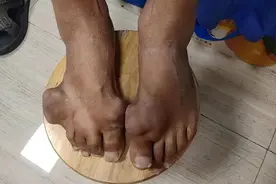 长了痛风石怎么处理掉？图片