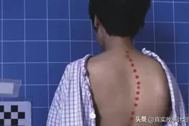 脊柱侧弯，青少年健康杀手图片
