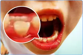 医生提醒：7岁前一定关注这颗牙，蛀了没得换！很多娃发现时晚了图片