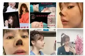 演员高溜整容失败，鼻子严重坏死，她经常想自杀：整容需谨慎图片