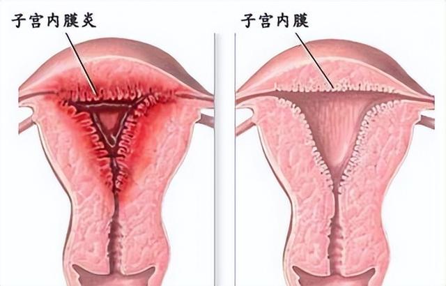 子宫内膜回声不均匀？到底是什么病