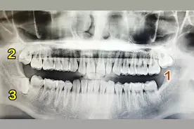 成人智齿拔除攻略，从发现到拔除术后反应全流程经验分享图片