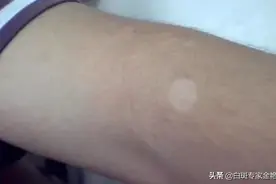 初期白癜风症状图片