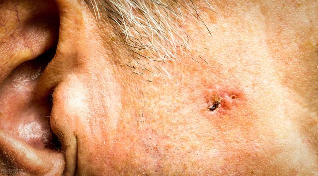 毛囊角化养生堂