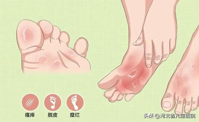 脚气or湿疹?傻傻分不清?