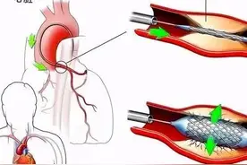 冠心病什么情况下需要放置支架？图片