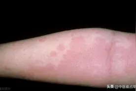 荨麻疹就是一团风，防风配一物，行血，祛风，清热，赶走顽疹图片