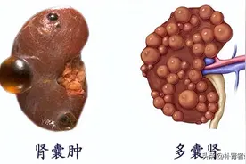 一文看懂肾囊肿是怎么回事图片