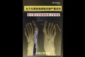 好看也痛苦！女子长期穿高跟鞋导致双脚变形图片