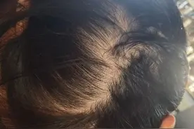 四种方法教你快速判断是不是脱发图片