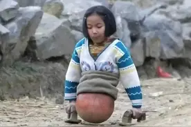 4岁时失去双腿，靠半个篮球走路！曾经感动中国的女孩，如今怎么样了？图片