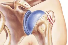 肩关节脱位怎么办？图片