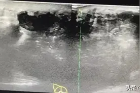 痛心！福州女子患乳癌信偏方拒绝手术，拖到晚期溃烂险送命图片