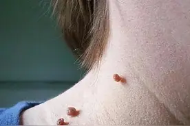 脖子和腋下的“小肉粒”是什么？能直接用手揪掉吗？告诉你答案图片