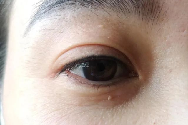 角化棘皮瘤的病理要点