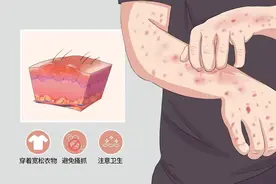 皮肤剧烈瘙痒，竟是湿疹！史上最全13种治湿疹中成药，医生总结图片