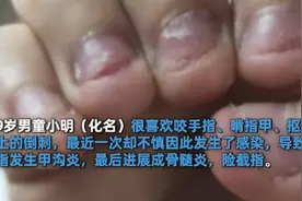 孩子咬指甲、撕倒刺，一般难逃3种结局，背后“心理原因”需重视图片