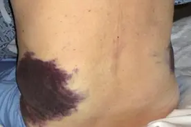 胰腺炎是什么症状，哪个位置痛图片