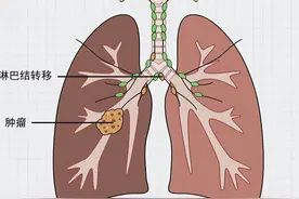 肺癌并不是无征兆，脸上出现这3种“怪象”，要时刻引起注意图片