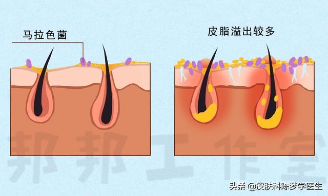脸皮质角化