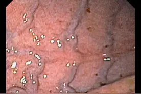 肝硬化门静脉高压食管胃静脉曲张出血的防治指南图片