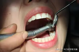 补牙后，牙齿酸痛的原因在这图片