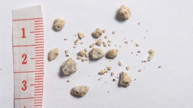 肾脏B超提示“多囊肾”，严重么？医生坦言：有一半人变尿毒症