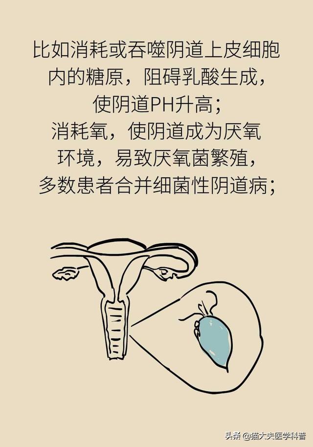 滴虫性阴道炎是很严重的妇科病吗？会不会传染？