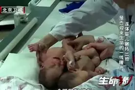 罕见臀部相连双胞胎姐妹图片