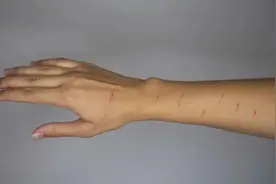 磕破皮、划道杠、烫起泡、割到肉，提问：哪种伤口要打破伤风？图片