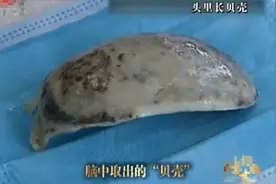2007年重庆14岁男孩做手术，医生打开头颅，竟取出一个大“贝壳”图片