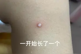 聊一聊传染性软疣自愈图片