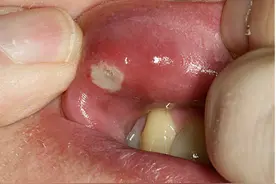 好痛！发生口腔溃疡怎么办？怎么预防和治疗呢？图片