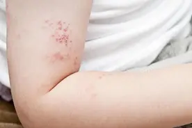 打完带状疱疹疫苗后，很后悔~图片