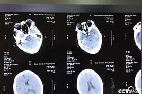 贺教授依据测算 ——脑膜瘤增长速度图片