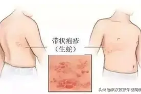 身上像针扎一样刺痒还有很小很小的小水泡怎么回事图片