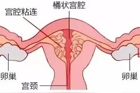月经量变少，检查发现宫腔粘连了？图片