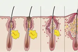 青春期孩子满脸痘？皮肤科专家给您支招图片