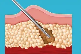 「九院韦敏教授」吸脂后为什么会感觉又胖了图片