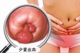 宫颈息肉多大才要去割掉？图片