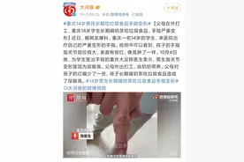 重庆男童被奶奶活活喂成畸形！婆媳反目：谁让你天天给娃喝这个图片