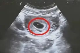 hcg2.4万出现空孕囊？揭秘空孕囊形成的7大原因，早知道早预防图片