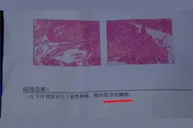 恶性肿瘤是怎么分期的？有没有通用的方法？图片