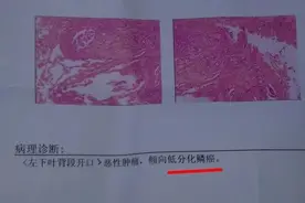 恶性肿瘤是怎么分期的？有没有通用的方法？图片