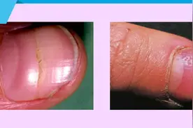 对图自查！指甲长出褶皱or凹点是得了什么大病吗？图片