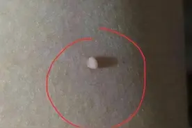 脖子和腋下的“小肉粒”是什么？能直接用手揪掉吗？告诉你答案图片
