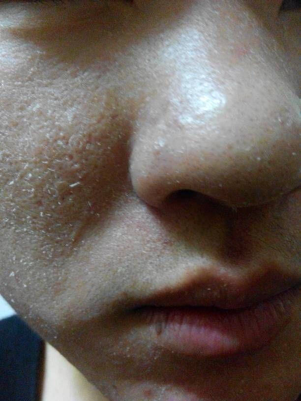 脸上起皮是死皮吗?要怎么处理?