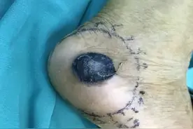 医生，身上长了个色素痣需要切除吗？会不会变成恶性黑素瘤？图片