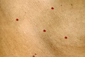 身上有小红痣，就代表肝脏有问题？医生帮你分析图片