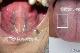 舌下青筋又粗又黑？血瘀很严重？如何调理？总结了中成药送给你图片